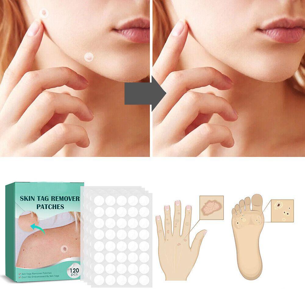 DermaClear – Ensemble de traitement efficace contre les boutons et les verrues