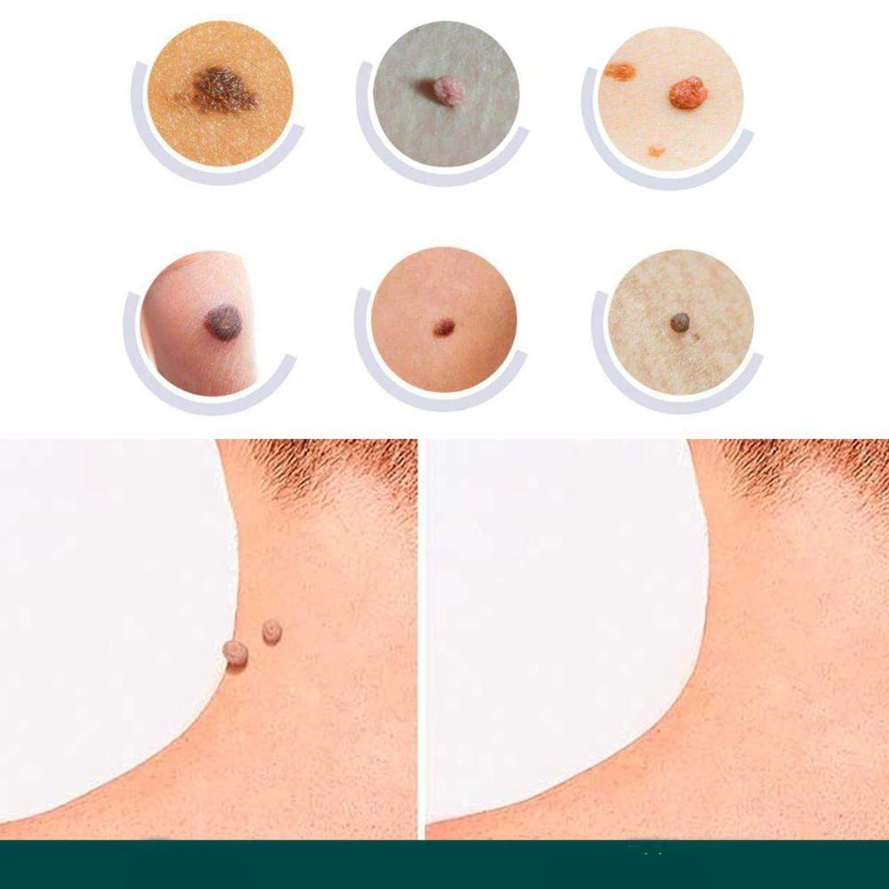 DermaClear – Ensemble de traitement efficace contre les boutons et les verrues